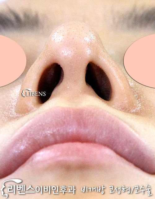무보형물 매부리코 메부리코 코끝 수술 성형 연골재배치 성형 s561